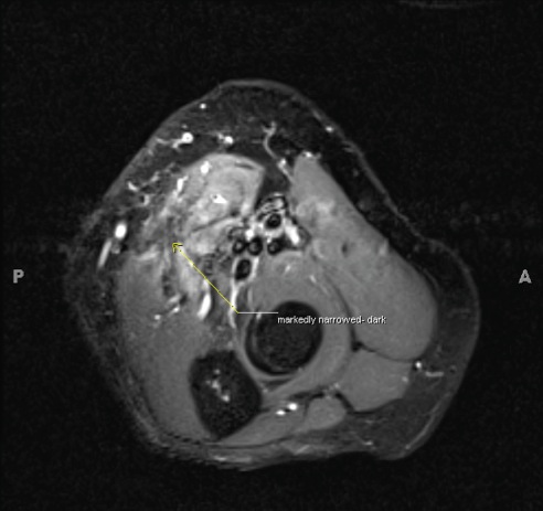Figure 2 for case Ulnar nerve failed transposition